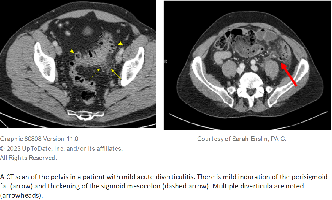 Graphic 80808 Version 11.0. Copyright 2023 UpToDate, Inc. and/or its affiliates. All Rights Reserved. Courtesy of Sarah Enslin, PA-C. A CT scan of the pelvis in a patient with mild acute diverticulitis. There is mild induration of the perisigmoid fat (arrow) and thickening of the sigmoid mescolon (dashed arrow). Multiple diverticula are noted (arrowheads).