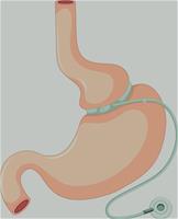iStock-543679086 bariatric for clinical topics