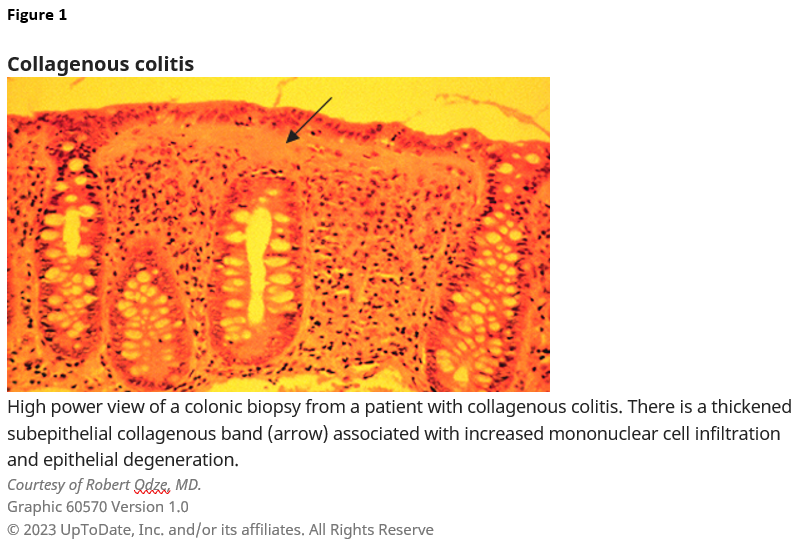 Figure 1. Collagenous colitis. High power view of a colonic biopsy from a patient with collagenous colitis. There is a thickened subepithelial collagenous banc (arrow) associated with increased mononuclear cell infiltration and epithelial degeneration. Courtesy of Robert Odze, MD. Graphic 60570 Version 1.0. Copyright 2023 UpToDate, Inc. and/or its affiliates. All Rights Reserve.