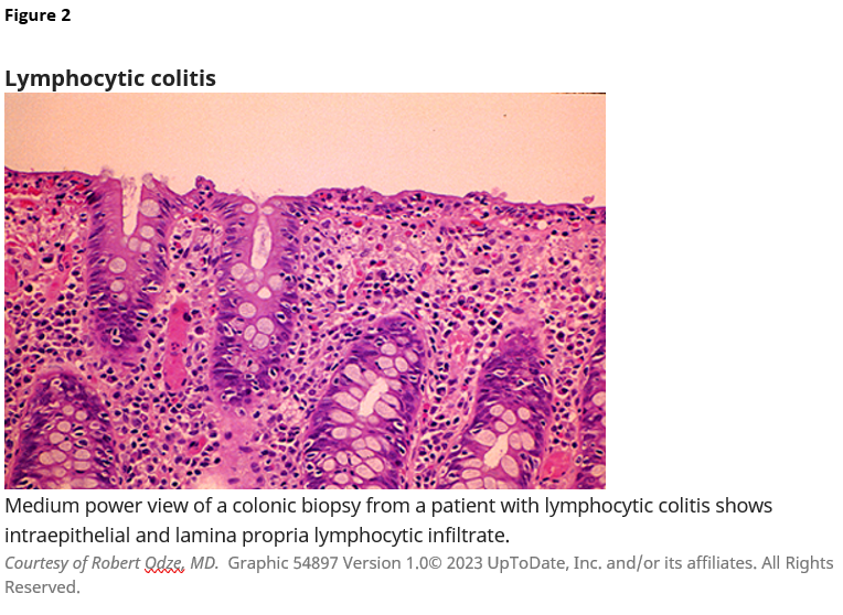 Figure 2. Lymphocytic colitis. Medium power view of a colonic biopsy from a patient with lymphocytic colitis shows intraepithelial and lamina propria lymphocytic infiltrate. Courtesy of Robert Odze, MD. Graphic 54897 Version 1.0. Copyright 2023 UpToDate, Inc. and/or its affiliates. All Rights Reserved.