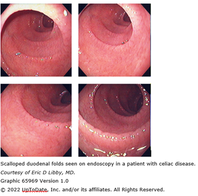 Scalloped duodenal folds seen on endoscopy in a patient with celiac disease. Courtesy of Eric D Libby, MD. Graphic 65969 Version 1.0. Copyright 2022 UpToDate, Inc. and/org its affiliates. All Rights Reserved.