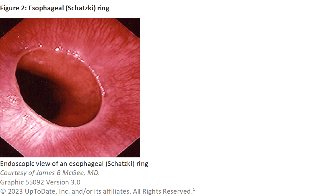 Schatzki ring