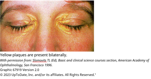 Yellow plaques are present bilaterally. With permission from: Slomovits, TL (Ed), Basic and clinical science courses section, American Academy of Ophthalmology, San Fransisco 1996. Graphic 67919 Veresion 2.0. Copyright 2023 UpToDate, Inc. and/or its affiliates. All Rights Reserved.